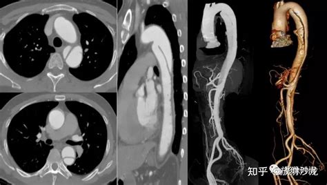 看过的都懂了 急性主动脉综合征 CTA 表现 知乎