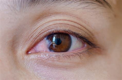 Pinguecula Vs Pterygium Whats The Difference Discover Vision