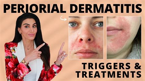 první Pružnost volba perioral dermatitis retinol Vtipný Dekódovat Chléb