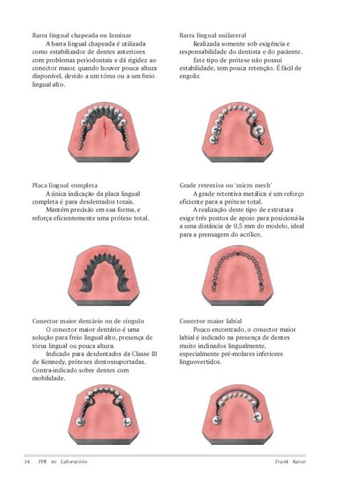 Prótese Parcial Removível Odontológico Dentistry Dental Dental life