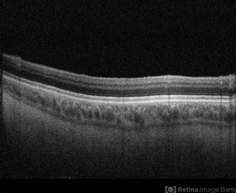 Ocular albinism - Retina Image Bank