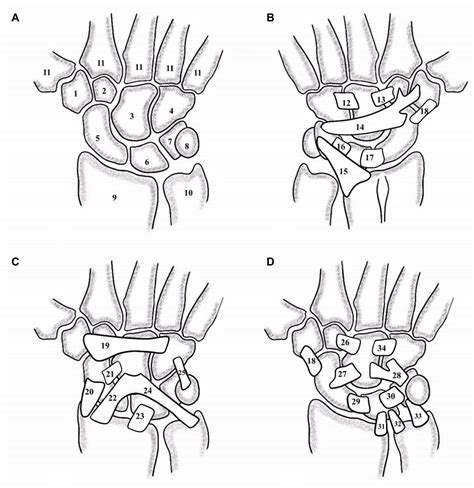 Optimal Management Of Scapholunate Ligament Injuries Orr