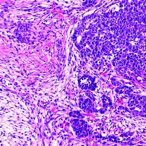 Wilms Tumour Mixed Pattern With Blastema Stroma And Single