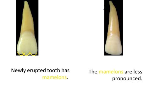 Upper Lateral Incisor