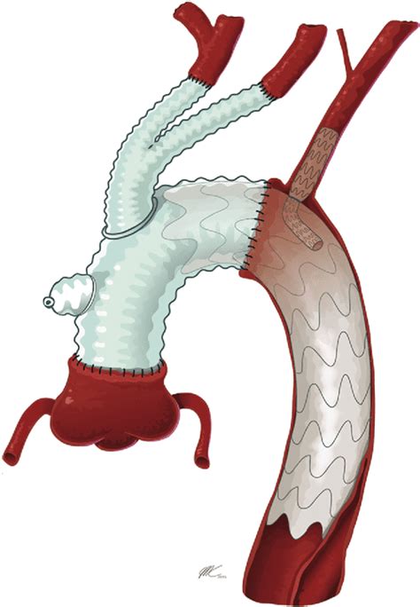 Zone Arch Replacement And Staged Thoracic Endovascular Aortic Repair