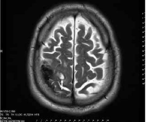 Cranial MRI Showing A Calcified Meningioma Located In The Right