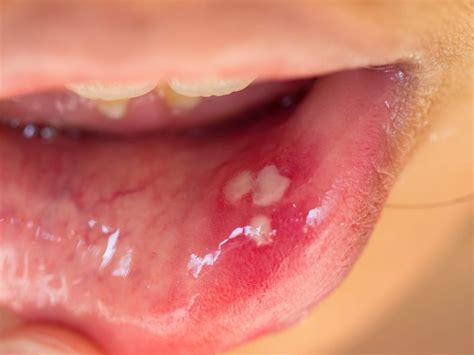 Canker Sore On Lip Swollen