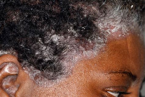 Pictures Of Sores And Scabs On Scalp Causes And More