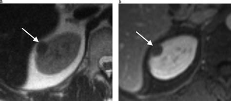 Renal Masses Measuring Under 2cm Pathologic Outcomes And Associations