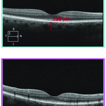 High Resolution 5 Line HD Scan OCT Horizontal And Vertical Line OCT B