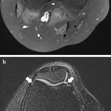 A 16 Year Old Male Patient With Atraumatic Knee Pain A T1 Weighted