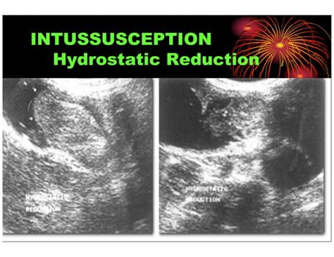 Pediatric Intussusception An Overview Ppt