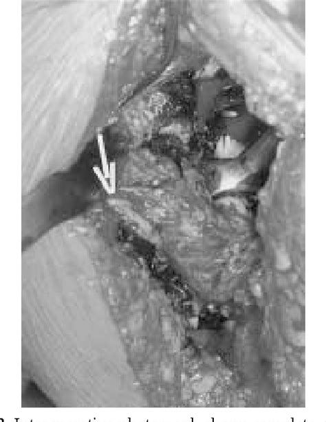 Figure From Rare Case Of Sciatic Nerve Palsy In A Modular Total Hip