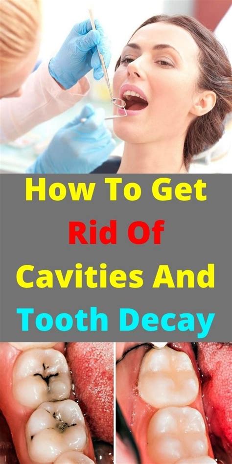 How To Get Rid Of Cavities And Tooth Decay In 2020 Dental Decay