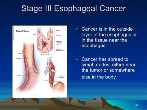 11 Esophageal Cancer