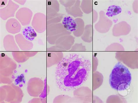 Plasmodium Falciparum Schizonts Merozoites And Haemozoin