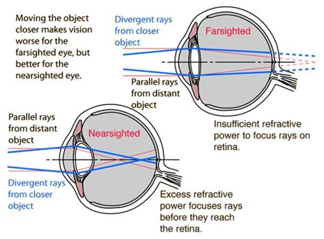 Hyperopia Ray Diagram