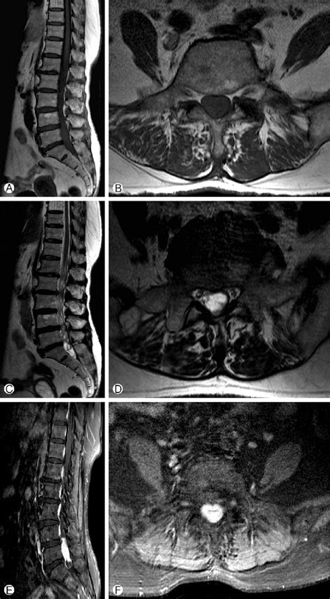 Preoperative Magnetic Resonance Mr Imaging Shows A Low Intensity Mass