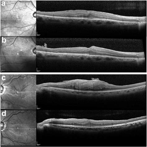 Representative Preoperative Optical Coherent Tomography Oct Images Of