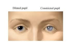 Dilated Pupils - Definition, Symptoms, Causes, Diagnosis and Treatment