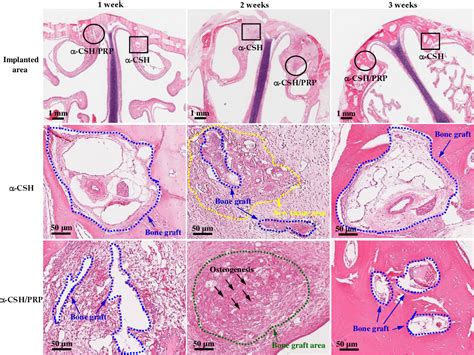 [PDF] An Innovative Bioceramic Bone Graft with Platelet-Rich Plasma for ...