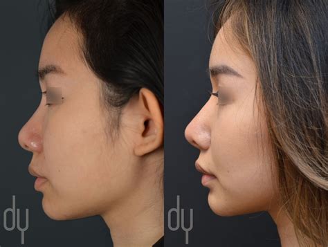 Before And After Primary Asian Rhinoplasty With Rib Cartilage Rhinoplasty Septoplasty