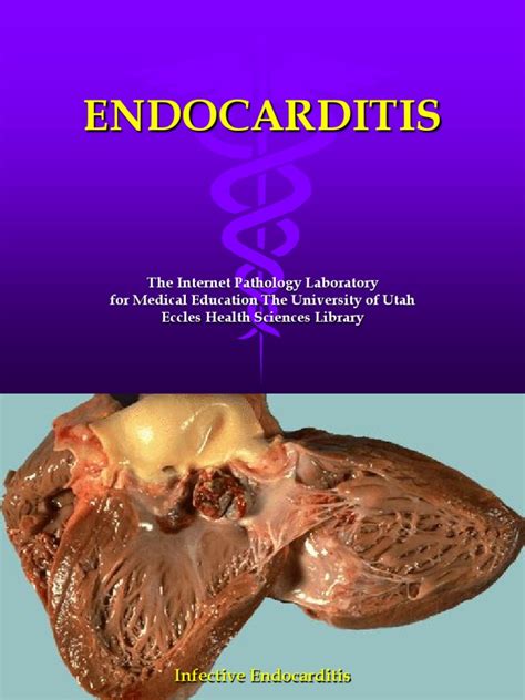 Endocarditis Pdf Heart Valve Internal Medicine