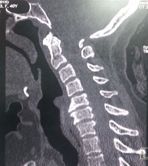 A Sagittal Computed Tomographic Ct Scanning Cervical Spine Image Of A