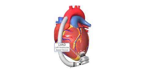 How Left Ventricular Assist Device Tackle End Stage Heart Failure