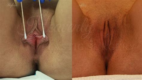 Labiaplasty Gallery Heavenly Plastic Surgery