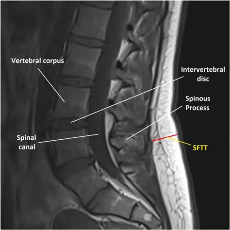 Are Paraspinal Muscle Quantity Lumbar Indentation Value And