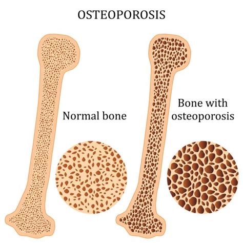 What Is Glass Bone Disease Osteogenesis Imperfecta Turkey Istanbul