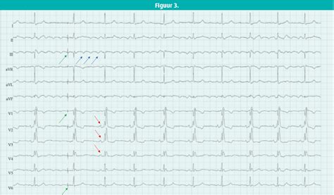 Twee Ritmes In één Tijdschrift Voor Cardiologie