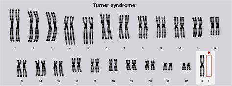 Sindrome di Turner cosè e come intacca anche il cuore SISMED