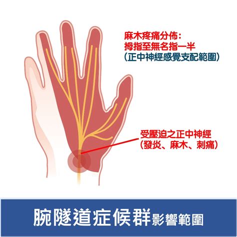 手麻？腕隧道症候群？一次瞭解治療方式