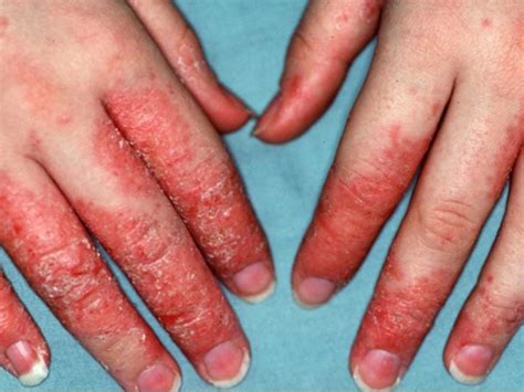 Eczema/Atopic Dermatitis | McLean & Woodbridge VA