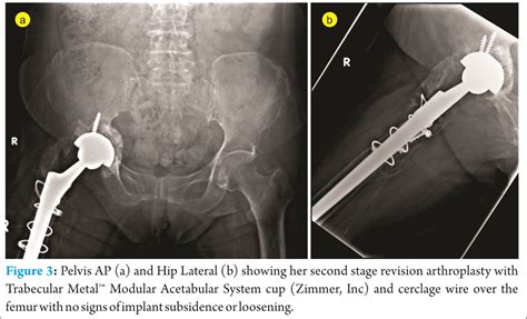 Acetabular Prosthetic Protrusio After Bipolar Hemi Arthroplasty Of The