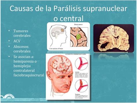 Paralisis Facial Periferica Ppt