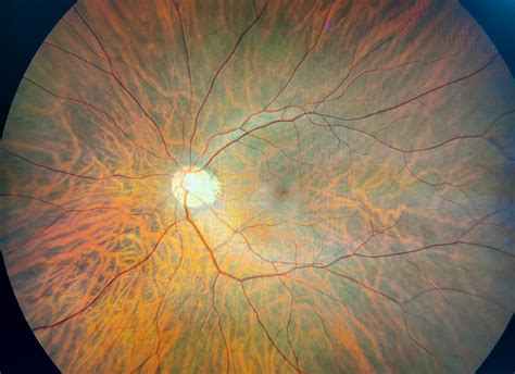 Optometry Atlas Vitreoretinal Interface Abnormalities Viewpoint