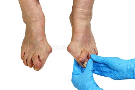 Medecin Valgus Bunion Leg With Deformation Valgus Hallux Bunion Stock