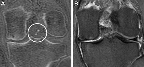 Zero Echo Time Musculoskeletal MRI Technique Optimization