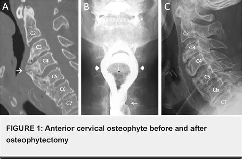 Figure 1 From Symptomatic Anterior Cervical Osteophyte Causing Dysphagia Case Report Imaging