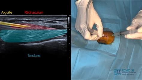 Ténotomie à l aiguille d une ténosynovite de De Quervain sous écho