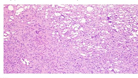 Dermatofibrosarcoma Pathology Outlines