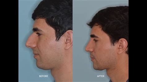 Male Rhinoplasty Reducing The Hump Anthony Bared Md Facs Miami Fl