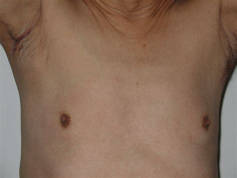 Chest Lymph Node Swelling Hot Sex Picture