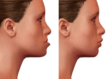 Jaw Surgery Combined Treatments Insight Orthodontics