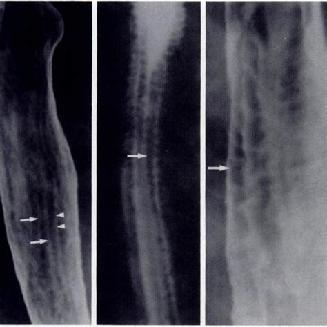 (PDF) Glycogenic acanthosis of the esophagus