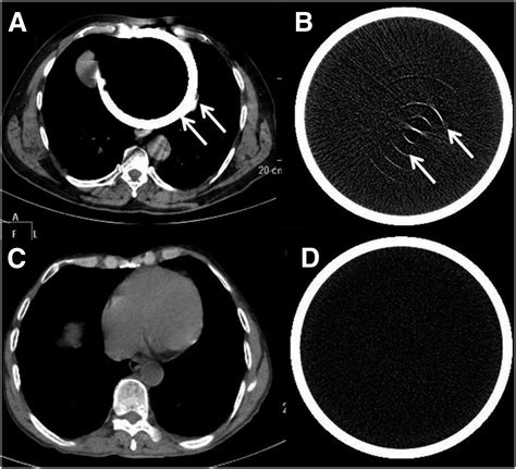 An Unusual Cause Of The Ring Artifact On Transaxial Ct Images Journal