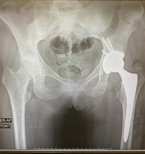 Prótesis de Cadera Protesis Total De Rodilla